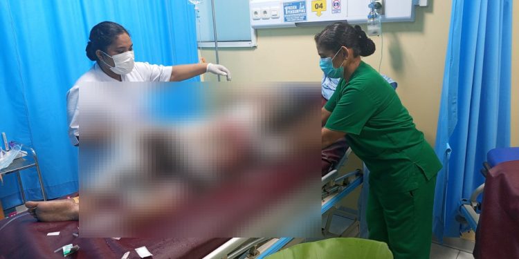 Gadis 15 Tahun di Jayapura Meninggal Usai Dibakar